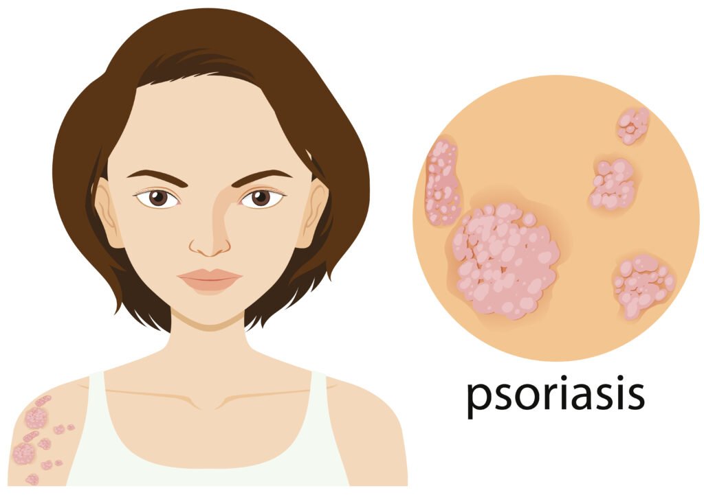 psoriasis