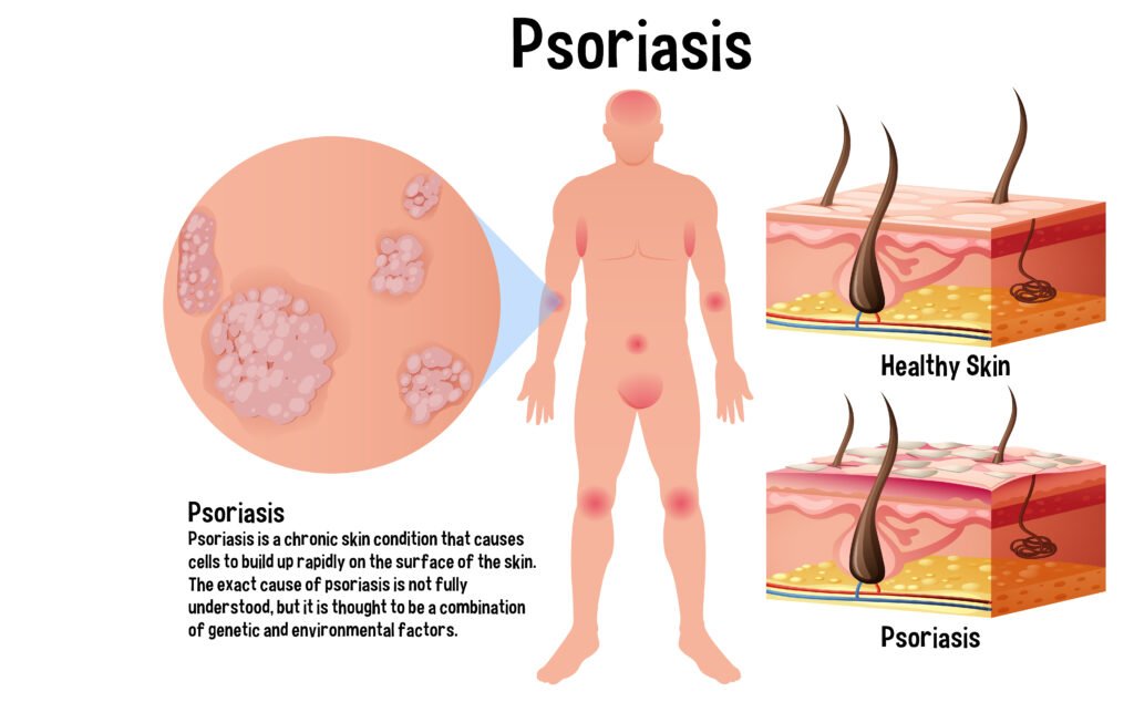 psoriasis