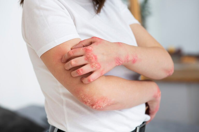 Psoriasis Relief: What It Is, How It Develops, and Proven Ways to Manage It.